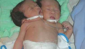 Sửng sốt thương những đứa trẻ 2 đầu, 4 tay