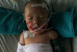 Thương tâm bé 6 tháng tuổi bỏng 50% vì trời lạnh