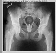 Khó tin những ca dị vật mắc trong cơ thể