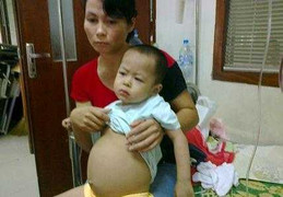 'Bụng to, thịt teo, cháu chỉ có thể nằm thoi thóp'