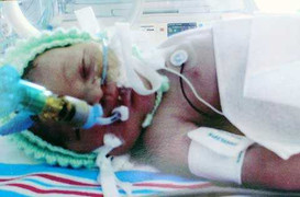 Dây rốn quấn cổ, đầu kẹt trong ống sinh, em bé tử vong