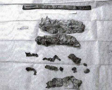 16 dụng cụ y tế bị bỏ sót trong cơ thể một bệnh nhân