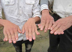 Người dị tật 6 ngón chật vật thi bằng lái xe