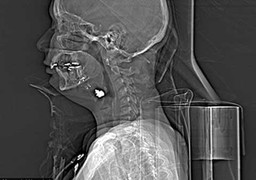 Viên đạn xuyên má, trôi xuống cổ vẫn sống