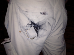 Bỏng vì pin điện thoại nổ tung trong quần