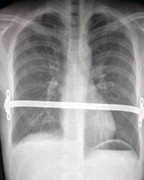 Cứu sống người đàn ông có lồng ngực đè bẹp tim, phổi