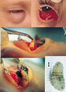 Đeo kính áp tròng: Ấu trùng làm tổ trong mắt?