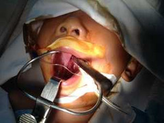 Cứu sống bé 5 tuổi bị đũa xuyên đáy sọ