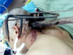 Côn đồ dùng cào sắt bổ vào đầu công an