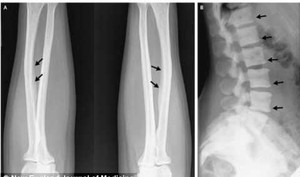 Mê uống trà bị rụng hết răng, mắc bệnh lạ