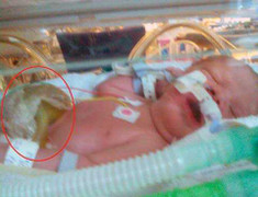 Kỳ diệu sức sống em bé có nội tạng ngoài cơ thể