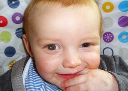 Ung thư hiếm khiến mắt biến thành mắt mèo