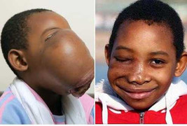 Khối u 2 kg trên mặt biến cô bé thành hà mã