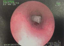 Bé 3 tuổi thở ra tiếng kèn te te