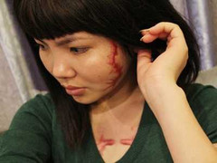 'Cô gái mặt rết' nhận 400 triệu đồng bồi thường