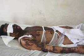 Một cán bộ thuế bị tạt axit tại nhà riêng