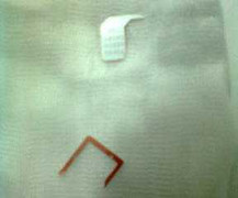 Giật mình SIM điện thoại mắc trong thực quản trẻ