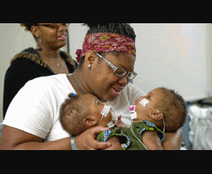 Tách thành công cặp sinh đôi dính tim, gan