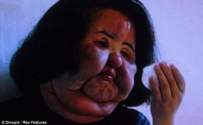 Tự bơm dầu ăn vào mặt, người mẫu Hàn biến thành ‘quỷ’