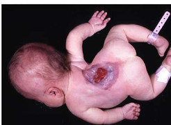 Phó giáo sư tư vấn tránh sinh con dị tật ống thần kinh