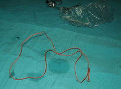 Nhét cúc áo, dây điện cả mét vào 'vùng kín'