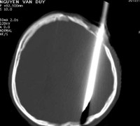 Một thanh niên bị dao đâm xuyên đầu