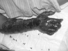 Vi khuẩn ăn thịt tấn công quý ông 40 tuổi