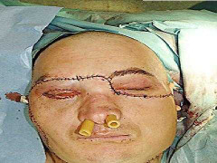 Máy cắt đá 'nuốt' gần trọn khuôn mặt