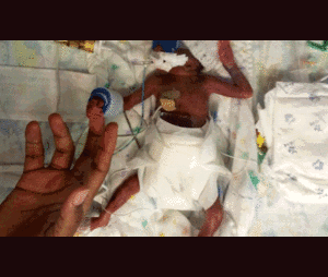 Bé sinh non sống sót kỳ diệu sau 7 lần chết hụt