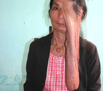 Người phụ nữ có khối u dài 40cm được cứu thế nào?