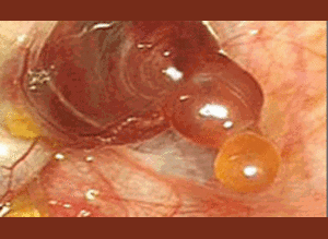 Bà bầu bị ruột thừa, bác sĩ cắt nhầm buồng trứng