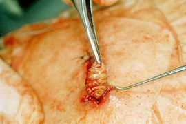 Xót xa người có dòi bò lúc nhúc trong xương