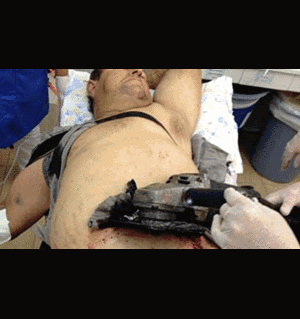 Cảnh máy xẻ gỗ ngập sâu 10 cm trong bụng