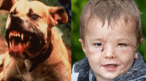 Thương bé trai bị chó cắn nát mặt