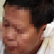 Công an thị trấn bị cắn đứt vành tai