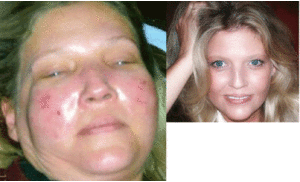 Trước xinh, sau thẩm mỹ mặt như ngáo ộp