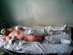 Người đàn ông bị đứt lìa tay trái