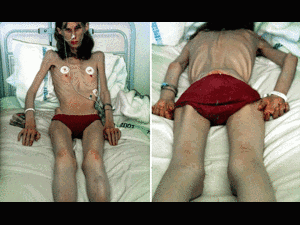 Chỉ vì ăn kiêng, cô gái biến thành bộ xương thế này