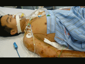 Căn bệnh lạ lây lan chóng mặt ở Kon Tum