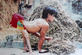 Ảnh: Quặn lòng thảm họa da cam ở Việt Nam