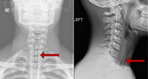 Cậu bé bị phi tiêu mắc ở cổ họng