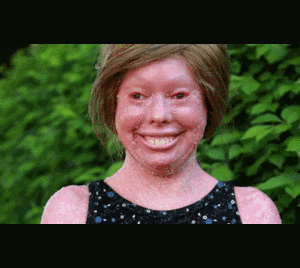 Bệnh lạ biến nữ sinh thành tượng