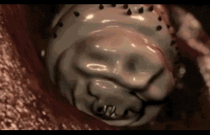 Giòi ăn thịt người bò lúc nhúc trong bụng