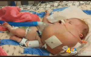 Xót xa bé sơ sinh có khối u miệng khổng lồ