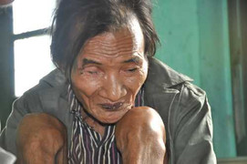 Tin mới nhất về sức khoẻ 'người rừng' 82 tuổi