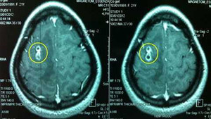 Người đàn bà bị giun chui vào não