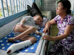 Tứ chi thối rữa, rụng dần là bệnh gì?