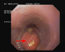 Được giáo sư hội chẩn mới phát hiện ung thư