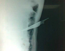 Bị truy đuổi, tội phạm truy nã đâm vào bụng tự sát