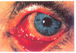 Đau mắt 'lạ', mất thị lực sau một đêm